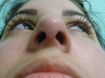 Nose Surgery