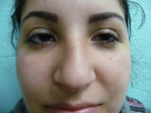 Nose Surgery Case 7523 Before Photo Nose Surgery