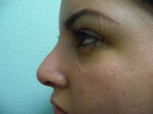 Nose Surgery Case 7523 After Photo Nose Surgery
