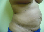 Liposuction