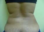 Liposuction