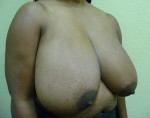 Breast Reduction