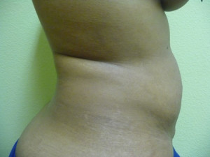 Liposuction Case 7416 After Photo Liposuction