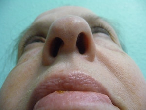 Nose Surgery Case 7609 Before Photo Nose Surgery