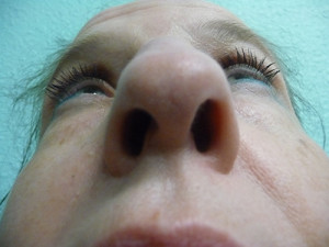 Nose Surgery Case 7609 After Photo Nose Surgery