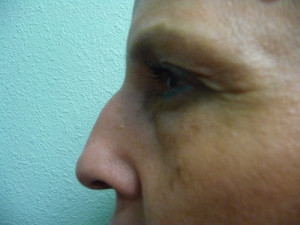 Nose Surgery Case 7609 After Photo Nose Surgery