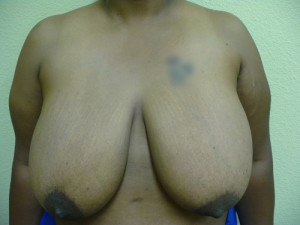 Breast Reduction Case 7910 Before Photo Breast Reduction