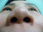 Nose Surgery