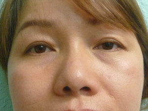Nose Surgery Case 7922 After Photo Nose Surgery