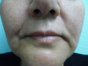 Fillers Case 7906 Before Photo Fillers