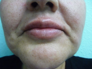 Fillers Case 7906 After Photo Fillers