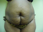 Tummy Tuck