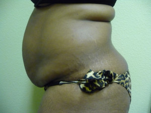 Tummy Tuck