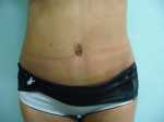 Tummy Tuck