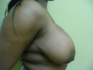 Breast Reduction Case 7706 Before Photo Breast Reduction