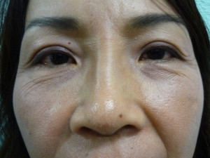 Nose Surgery Case 7712 After Photo Nose Surgery