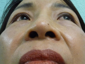 Nose Surgery Case 7712 After Photo Nose Surgery