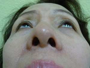 Nose Surgery Case 7720 After Photo Nose Surgery