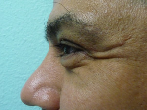 Eye Lid Surgery Case 7803 Before Photo Eye Lid Surgery