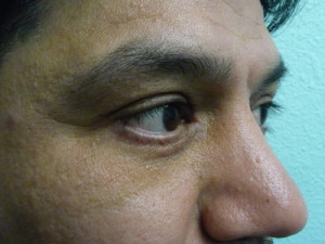 Eye Lid Surgery Case 7803 After Photo Eye Lid Surgery