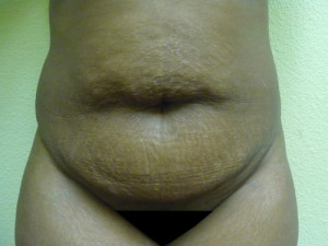 Tummy Tuck Case 7805 Before Photo Tummy Tuck