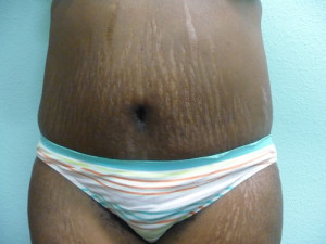 Tummy Tuck Case 7818 After Photo Tummy Tuck