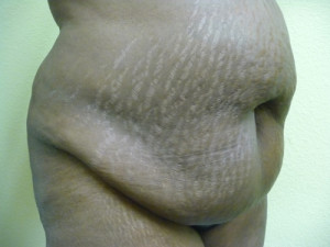 Tummy Tuck Case 7818 Before Photo Tummy Tuck