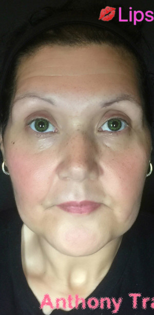 Fillers Case 7839 Before Photo Fillers