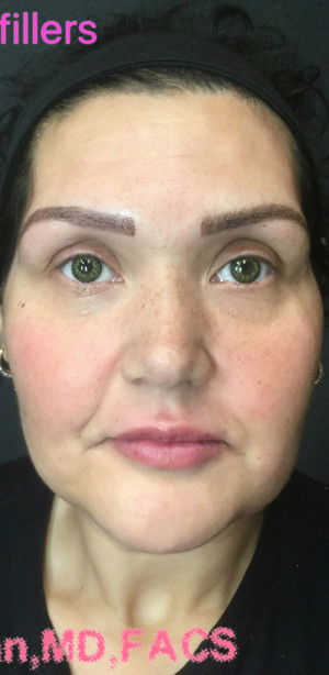 Fillers Case 7839 After Photo Fillers