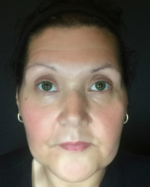 Microblading Case 7841 Before Photo Microblading