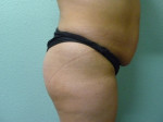 Butt Augmentation