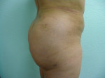 Butt Augmentation