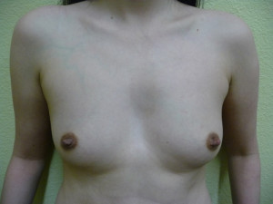 Breast Augmentation