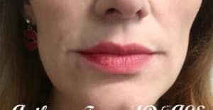 Fillers Case 8271 Before Photo Fillers