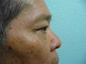 Eye Lid Surgery Case 8393 Before Photo Eye Lid Surgery