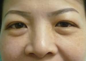 Eye Lid Surgery Case 8399 Before Photo Eye Lid Surgery