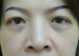 Eye Lid Surgery Case 8399 After Photo Eye Lid Surgery