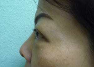 Eye Lid Surgery Case 8399 Before Photo Eye Lid Surgery