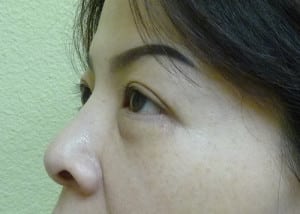 Eye Lid Surgery Case 8399 After Photo Eye Lid Surgery