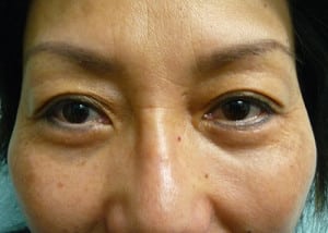 Eye Lid Surgery Case 8405 After Photo Eye Lid Surgery