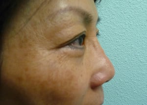 Eye Lid Surgery Case 8405 After Photo Eye Lid Surgery