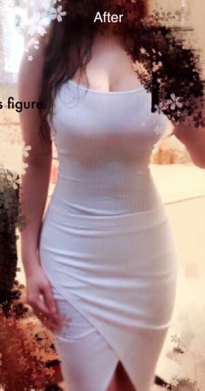 Liposuction