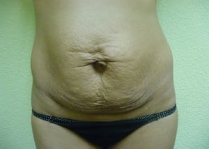 Tummy Tuck Case 8573 Before Photo Tummy Tuck