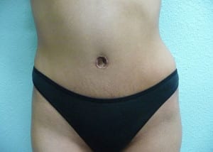 Tummy Tuck Case 8573 After Photo Tummy Tuck