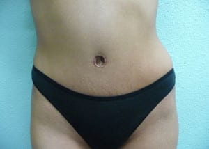 Tummy Tuck