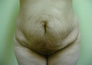 Tummy Tuck Case 8577 Before Photo Tummy Tuck