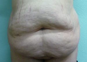 Tummy Tuck Case 8581 Before Photo Tummy Tuck