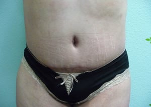 Tummy Tuck Case 8581 After Photo Tummy Tuck