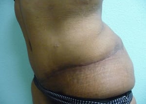 Tummy Tuck Case 8587 After Photo Tummy Tuck