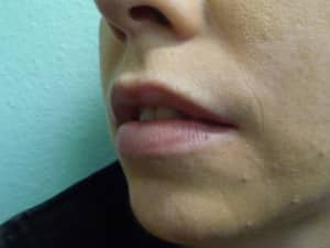 Lip Augmentation Case 8672 Before Photo Lip Augmentation